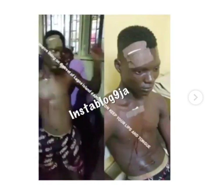 A boy has been arrested for biting off the lower lip and the tongue of a man at Apongbon, Lagos Island. The incident happened yesterday during a fight over where to erect a canopy. The victim, identified as Omo Adugbo, was said to have initiated the attack with a weapon. However, in retaliation, the suspect moved close to him and bit off his lip and tongue.