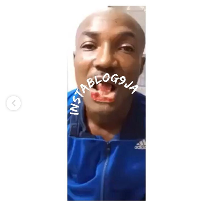 A boy has been arrested for biting off the lower lip and the tongue of a man at Apongbon, Lagos Island. The incident happened yesterday during a fight over where to erect a canopy. The victim, identified as Omo Adugbo, was said to have initiated the attack with a weapon. However, in retaliation, the suspect moved close to him and bit off his lip and tongue.