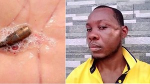 He was shot on the head by unknown gunmen closed to his resident at Alamieseigha Road Opolo, yenagoa #Bayelsa #State last year and was rushed to FMC and latter transferred to NDU teaching Hospital for a professional handling.