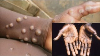 Lagos Leads As Monkeypox Spreads To 26 States