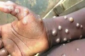 Abia state records first Monkey pox case