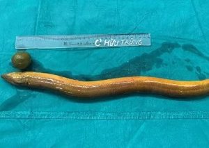 Man Who Put 65cm-Long Live Eel And Lemon Into His Anus Undergoes Live-Saving Surgery (Photos)