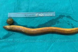 Man Who Put 65cm-Long Live Eel And Lemon Into His Anus Undergoes Live-Saving Surgery (Photos)