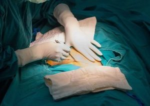 FG Announces Free Caesarean Sections For Women