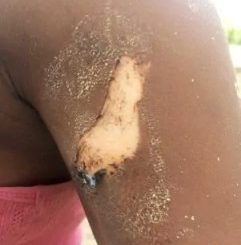 Osun tailor allegedly burns 17-year-old customer with hot iron over clothing dispute